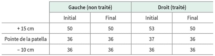 Étude de cas : traitement d'un lymphoedème par photobiomodulation