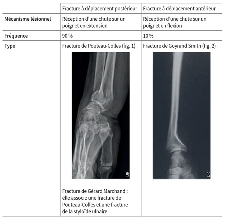 Les fractures extra-articulaires de l'extrémité inférieure du radius