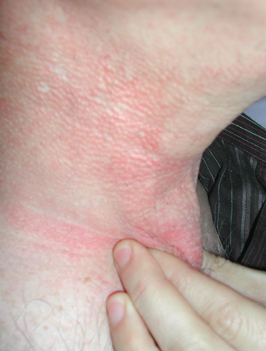 Cancer ORL : radiothérapie, kinésithérapie et fibrose tissulaire