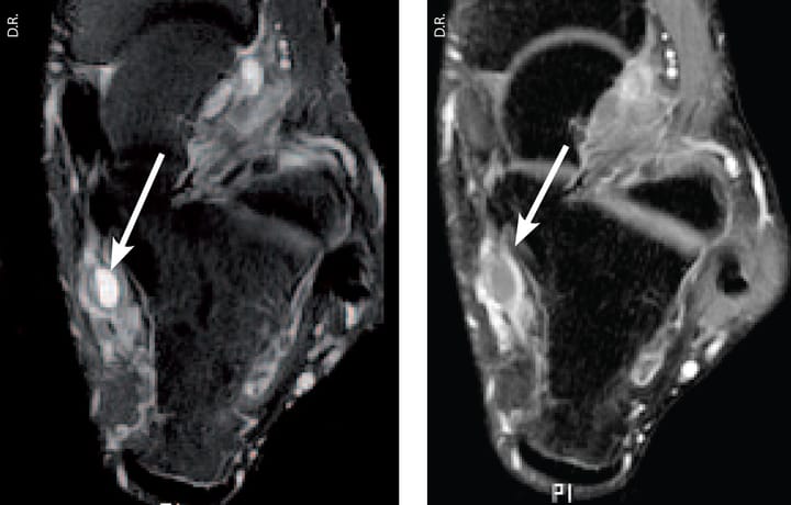 Syndrome du tunnel tarsien postéro-médial