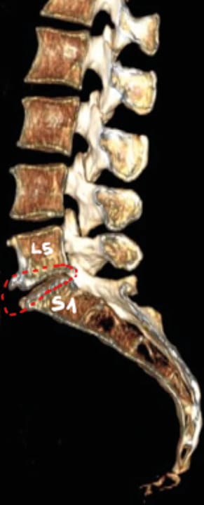 Lombalgies chroniques : traitement pharmacologique