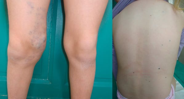 Malformations veineuses