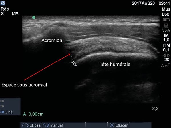 L'échographie musculo-tendineuse en rééducation : un outil prédictif ?