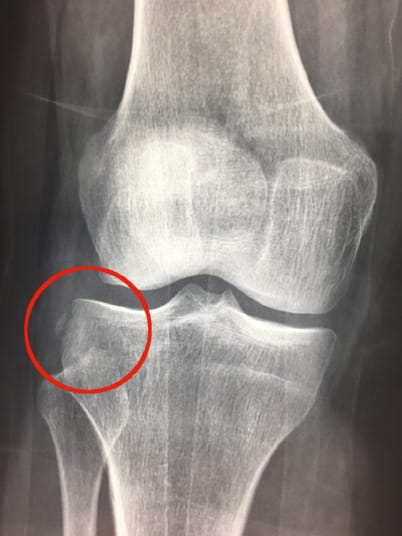 Mise au point : les plasties extra-articulaires du genou associées aux ligamentoplasties du LCA