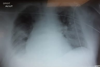L'échographie pulmonaire peut-elle orienter le choix du traitement en kinésithérapie respiratoire ?