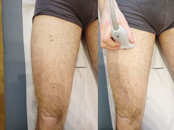 L'échographie musculo-squelettique du membre inférieur : sémiologie et applications échographiques en présence d'un syndrome fémoro-patellaire