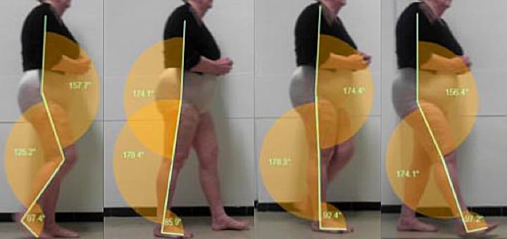 Le cadrage fonctionnel dans la récupération améliorée après chirurgie (RAAC) : application aux interventions du membre inférieur