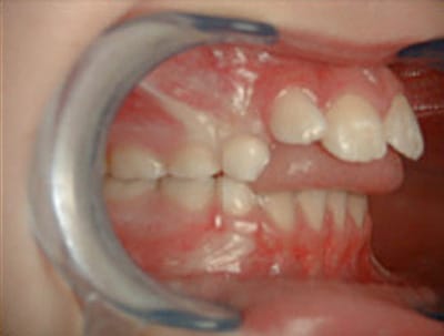 Étude prospective sur les dyspraxies oro-faciales et dysfonctionnement de l'appareil manducateur entre un groupe de nageurs et un groupe témoins
