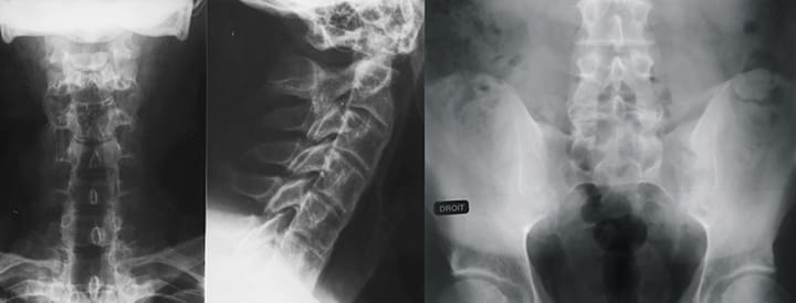 Apport de la physiothérapie inductive dans la prise en charge d’un patient atteint de spondylarthrite ankylosante