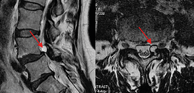 Kyste articulaire postérieur