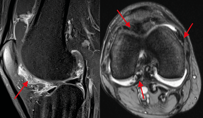 Synovite villonodulaire pigmentée