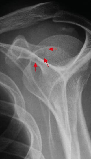 Fracture de la coracoïde