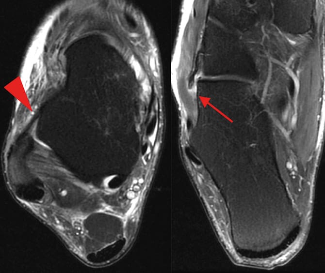 Rupture du ligament calcéno-cuboïdien