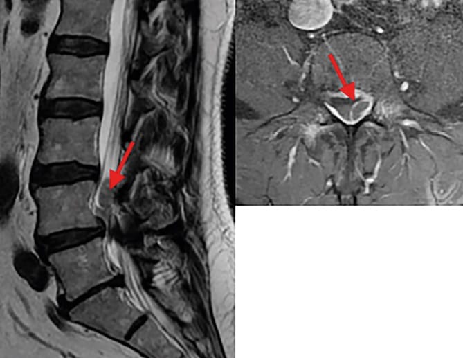 Hernie discale exclue