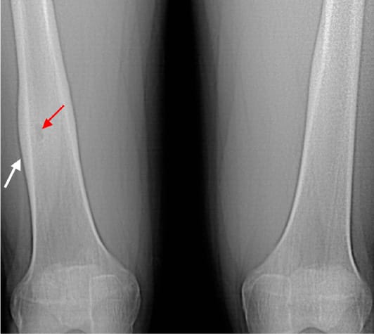 Ostéome ostéoïde du fémur