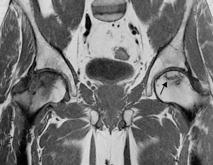 Ostéonécrose bilatérale des têtes fémorales