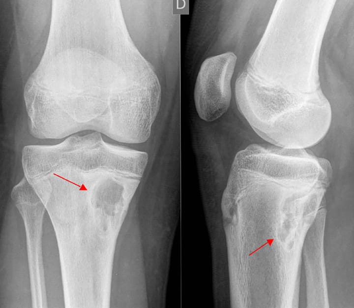 Lacune corticale métaphysaire