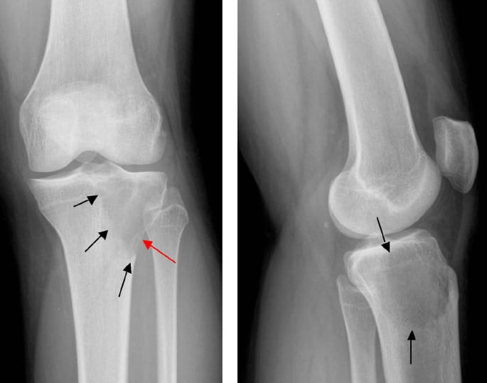 Tumeur à cellules géantes (TCG) du tibia