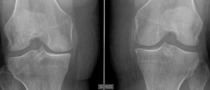 Ostéonécrose spontanée du condyle interne