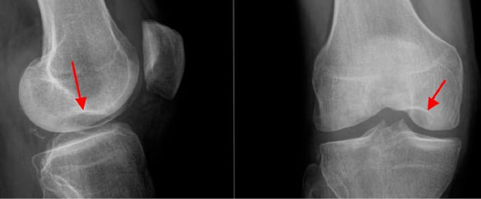 Ostéochodrite disséquante des condyles fémoraux