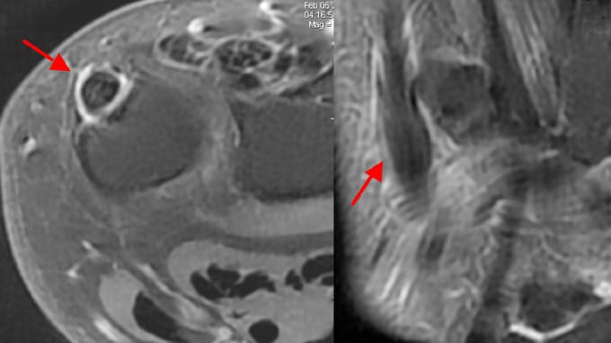 Tendinopathie de l'extenseur ulnaire du carpe