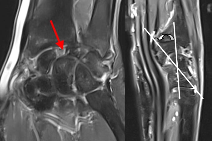 « SLAC wrist » (Scapho-Lunate Advanced Collapse)