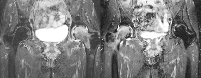 Oedème transitoire de hanche