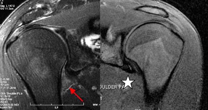 Capsulite rétractile