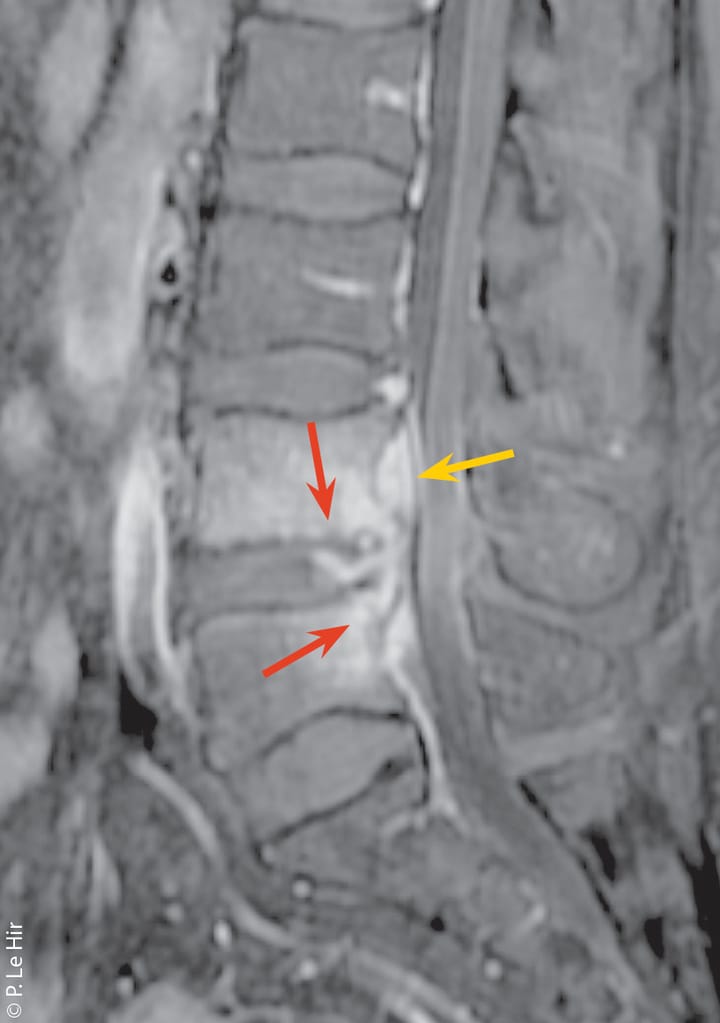L'imagerie médicale du lombalgique