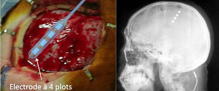 Bases sur l'utilisation de la stimulation magnétique transcrânienne répétitive à visée antalgique