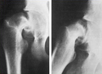 Épiphysiolyse (Slipped capital femoral epiphysis)