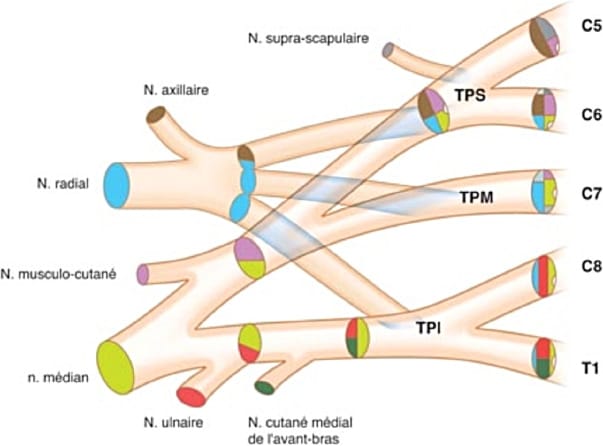La paralysie obstétricale du plexus brachial