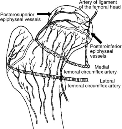 La maladie de Legg Calvé Perthès ou ostéochondrite primitive de hanche