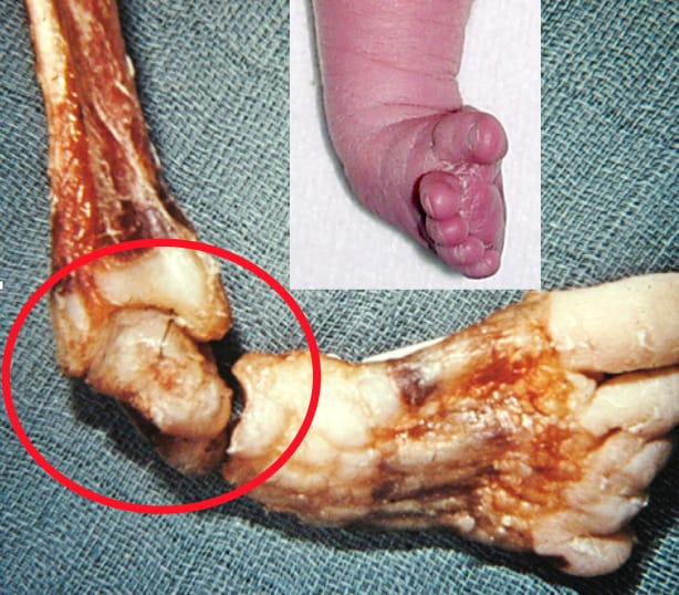 Traitement fonctionnel du pied bot varus équin selon la French method