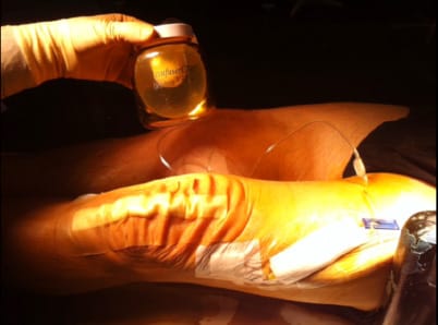 La place de la kinésithérapie dans la réhabilitation améliorée après chirurgie prothétique du genou