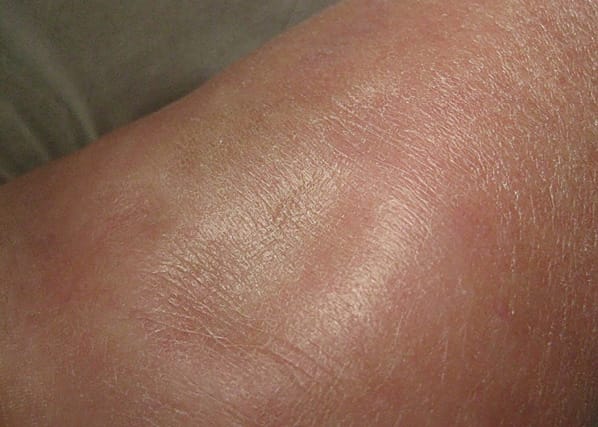 Échanges microcirculatoires et œdèmes