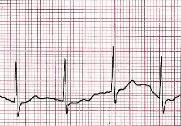 La cohérence cardiaque