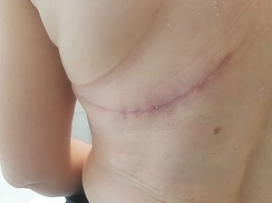 Prise en charge kinésithérapique des cicatrices après reconstruction mammaire par lambeau du grand dorsal