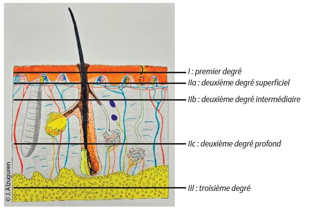 Kinésithérapie des grands brûlés : lésion initiale et conséquences