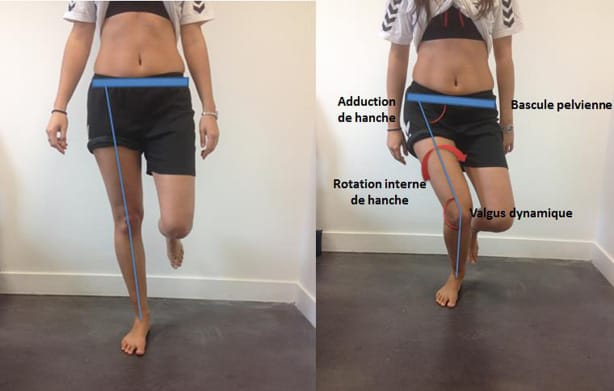 Intérêt du squat unipodal dans la prise en charge du syndrome fémoro-patellaire