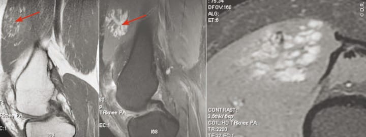 Angiome des parties molles