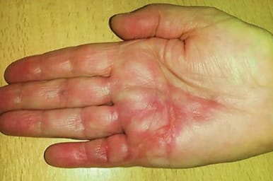 Rééducation après maladie de Dupuytren opérée : gérer la « flare reaction »