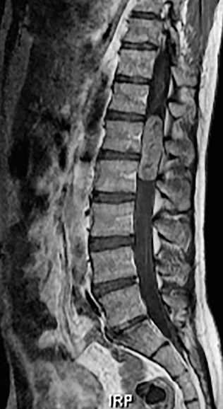 Épendymome myxopapillaire