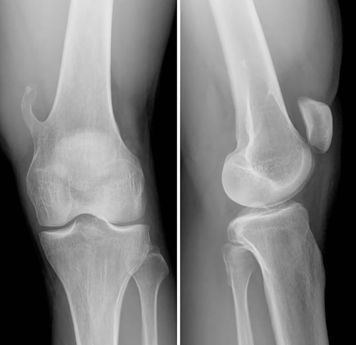 Ostéochondrome pédiculé isolé