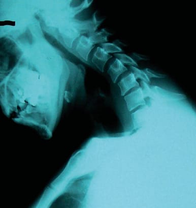 Relation entre posture cervicale et dysfonctionnement temporo-mandibulaire