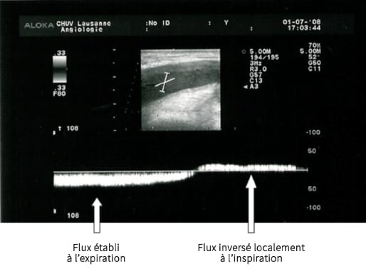 Les effets de différentes gymnastiques abdominales de type hypopressif sur le retour veineux du membre inférieur