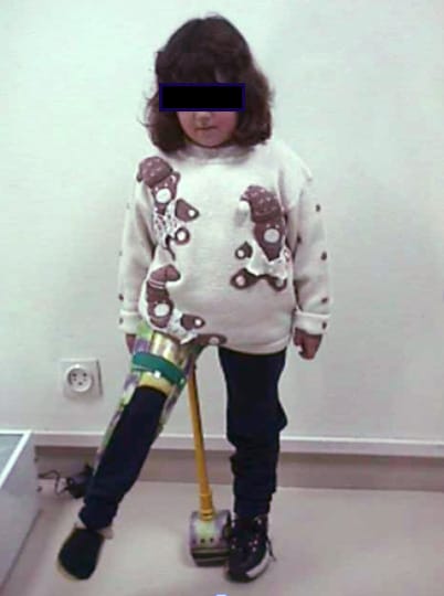 La maladie de Legg Calvé Perthès ou ostéochondrite primitive de hanche (2e partie)