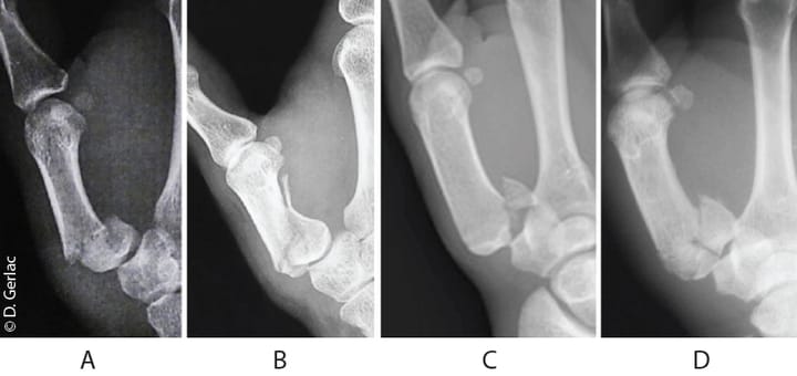 Rééducation après fracture du premier métacarpien (Bennett, Rolando) : quel protocole aujourd'hui ?