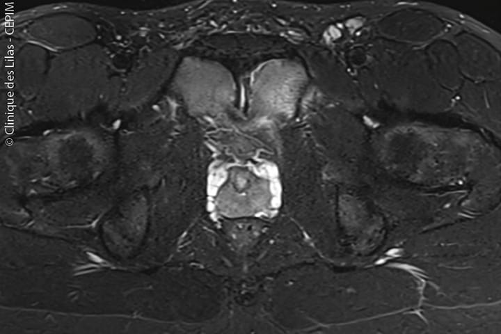 Ostéo-arthropathie symphysaire