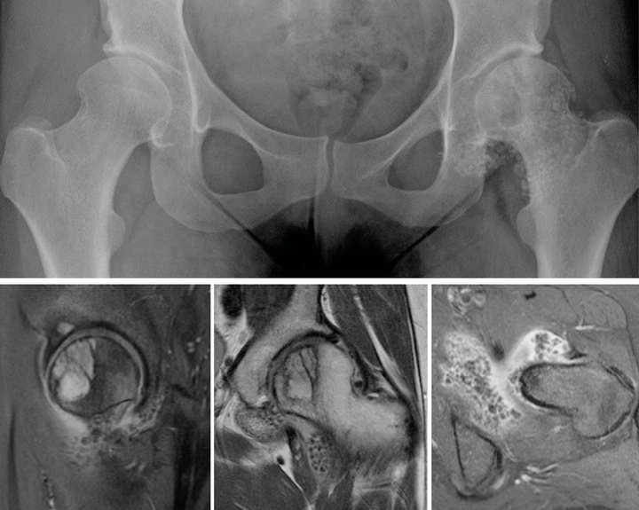 Ostéochondromatose synoviale primitive